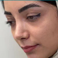 تخصص در انواع جراحی بینیی ترمیم ولیفت صورت پلک