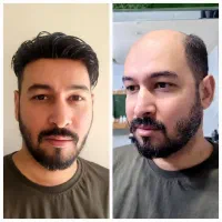 ریزش مو