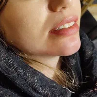 بوتاکس مصپورت.تزریقات وپانسمان و سوراخ کردن گوش