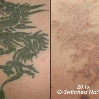 پاک کردن تاتو با دستگاه لیزر کیوسوییچ توسط پزشک