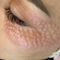 جوانساز پی آر پیprp صورت و ریزش مو و زخم و لک|خدمات آرایشگری و زیبایی|هشتگرد, شهرک ولیعصر (مصلی)|دیوار