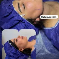 لیپو شکم پهلو ترنسفر به باسن ۴۵ م با شرایط اقساط