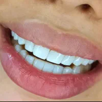تخفیف 50 درصدی کامپوزیت و دندان پزشکی|خدمات آرایشگری و زیبایی|تهران, ایوانک|دیوار