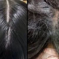 محلول پاکسازی شپش ورشک با ضمانت کتبی