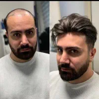 پروتز مو سنندج