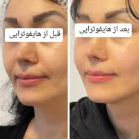 جوانسازی و لیفت صورت و بدن بدون جراحی و درد(هایفو)|خدمات آرایشگری و زیبایی|مشهد, کوثر|دیوار
