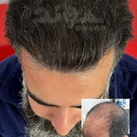 کاشت مو و ابرو با روش ویژه و تخصصی