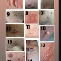محصول زگیل تناسلی و انواع زگیل