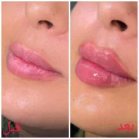 تخفیف به مناسبت روز مادر /ژل لب- کانتورینگ- بوتاکس