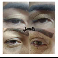 پلکسر مطبی پلاسما مزونیدلینگ خالبرداری مزو