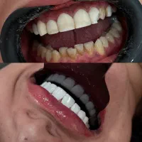 کامپوزیت دندان با برندهای معتبر جهانی|خدمات آرایشگری و زیبایی|اهواز, نادری|دیوار