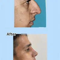 جراحی بینی با تخفیف استثنایی به مدت ۱۰روز|خدمات آرایشگری و زیبایی|بندرعباس, |دیوار