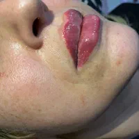 اف فیلرلب گونه چونه زاویه فقط 649|خدمات آرایشگری و زیبایی|محمدیه-قزوین, |دیوار