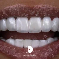 کامپوزیت دندان/لمینیت/دندانپزشکی|خدمات آرایشگری و زیبایی|مشهد, کوثر|دیوار