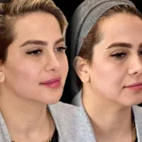 هایفو و جوانسازی پوست ویژه جشنواره یلدا ۸۹۰ت|خدمات آرایشگری و زیبایی|اصفهان, پروین|دیوار