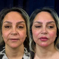 جشنواره لیفت با تخفیف 50٪ی بعلاوه بوتاکس رایگان