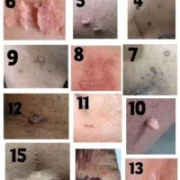 درمان قطعی زگیل و تبخال نواحی خصوصی