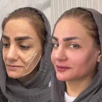 ژل و چربی|خدمات آرایشگری و زیبایی|ایلام, |دیوار