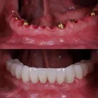 دندانپزشکی تخصصی ایمپلنت دیجیتالی و فوری|خدمات آرایشگری و زیبایی|تبریز, |دیوار
