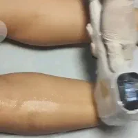 رفع موهای زاعد بالیزر دایود الکس ان دی یاگ