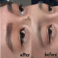 مدل میکروبلیدینگ