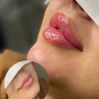 تزریق ژل،فیلر ،بوتاکس وانواع مزو(خانه سازی)