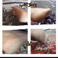 کرم ترک پا گیاهی با جواب دهی 3روزه|آرایشی، بهداشتی، درمانی|سوسنگرد, |دیوار