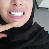 جشنواره ویژه کامپوزیت دندان