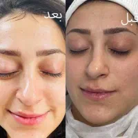 فشیال و پاکسازی پوست|خدمات آرایشگری و زیبایی|فیروزآباد (فارس), |دیوار
