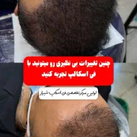 میکرواسکالپ فی اسکالپ سر|خدمات آرایشگری و زیبایی|شیراز, ملاصدرا|دیوار