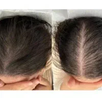 خدمات prpو prf|خدمات زیبایی و سلامت|کرمانشاه, |دیوار