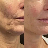 هایفو/لیفت پوست/کانتورینگ صورت/رفع غبغب