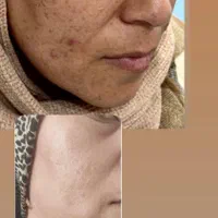 درمان تک جلسه ای تضمینی کک و مک ،لک،اسکار ،جوش|خدمات آرایشگری و زیبایی|قزوین, |دیوار
