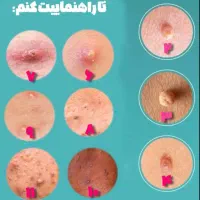 درمان قطعی زگیل تناسلی