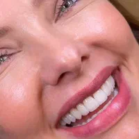 دندان ، دندانپزشکی ، لمینت ، کامپوزیت ، ایمپلنت