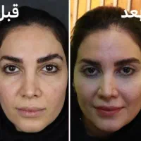 جراحی بلفاروپلاستی وجراحی های زیبایی و تزریقات|خدمات آرایشگری و زیبایی|قائمشهر, |دیوار