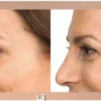 کرم بوتاکس|آرایشی، بهداشتی، درمانی|مراغه, |دیوار