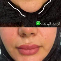 آف خدمات زیبایی فقط ۹۸۰ به مدت ۱هفته توسط پزشک|خدمات زیبایی و سلامت|اهواز, ۳۰ متری|دیوار