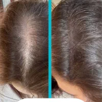 فیشال و مزونیدلینگ پوست و لیفت مژه ابرو و کاشت مژه|خدمات آرایشگری و زیبایی|تهران, تهرانپارس غربی|دیوار