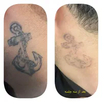 لیزرموزائد، پی آر پی، ریموتتو، فیلر، بوتاکس