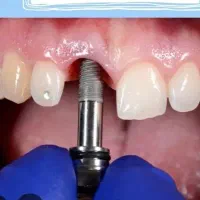 ایمپلنت اقساطی ماهیانه 2.5