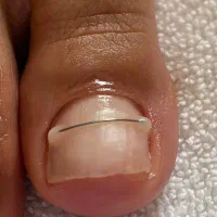 درمان ناخن توگوشت -اصلاح فرم ناخن -تخلیه قارچ ناخن