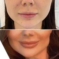 کاشت ابروعمل پلک لیفت کانتور بوکال لیپو غبغب، ژل|خدمات آرایشگری و زیبایی|کرج, عظیمیه|دیوار