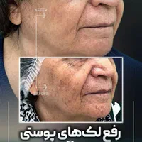 درمان کامل انواع لک پوستی توسط پزشک
