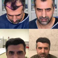 کاشتمو شیرازی برای آقایان با تخفیف ویژه|خدمات زیبایی و سلامت|شیراز, زرگری|دیوار