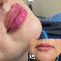 آموزش ژل،بوتاکس،لیفت،فیلربادی،انواع مزو مو و پوست