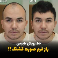 /کاشت مو / کاشت ابرو/بلفارو/رفع غبغب