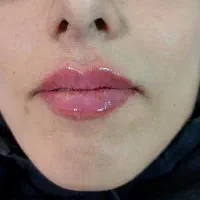 آفر فوری پکیج تزریق فیلر لب روسی و بوتاکس