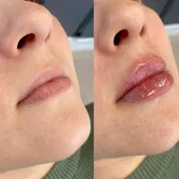 تخ*فیف ویژه خدمات زیبایی فیلر بوتاکس هایفوتراپی|خدمات آرایشگری و زیبایی|بوشهر, |دیوار