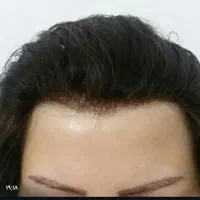 پروتز مو و ترمیم موی شقایق. چسب پروتز